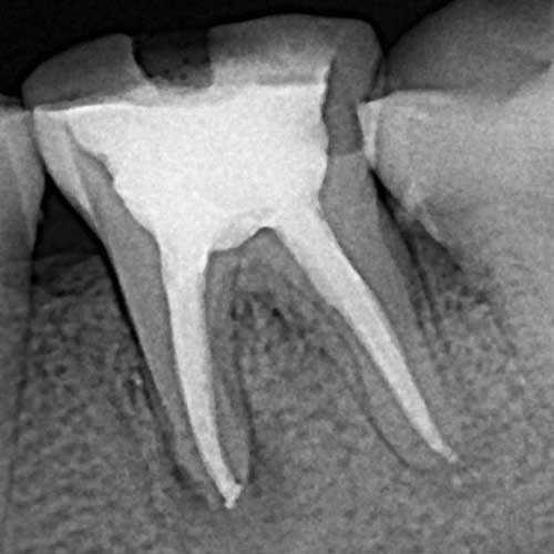 Лечение зубов под микроскопом в ростове