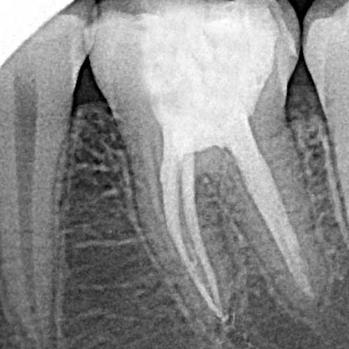 Лечение зубов с микроскопом в ростове