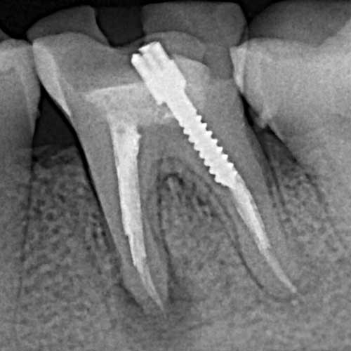 Лечение зубов под микроскопом ростов