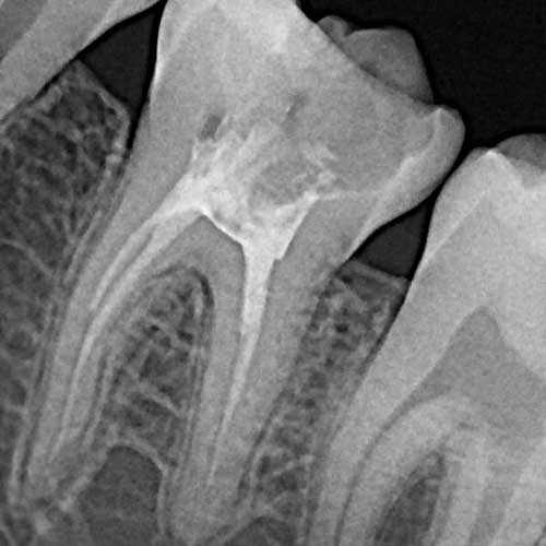 Лечение зуба с микроскопом ростов