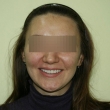 Исправление прикуса (Ольга, 28 лет) -Стоматология «ВИД»