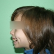 Исправление прикуса (Юлия, 12 лет)-Стоматология «ВИД»