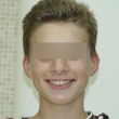 Исправление прикуса (Алексей, 12 лет)- Стоматология «ВИД»