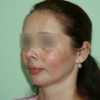 Исправление прикуса (Евгения, 38 лет) -Стоматология «ВИД»