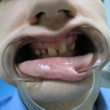 Протезирование зубов, виниры (Дмитрий, 26 лет)
