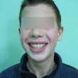 Исправление прикуса (Андрей, 13 лет) -Стоматология «ВИД»