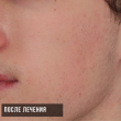 Лечение акне на лице (Игорь, 18 лет)-Косметология ВИД