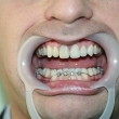 Комплексное стоматологическое лечение (Александр, 38 лет)
