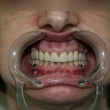Протезирование зубов, бюгельный протез (Галина, 50 лет)