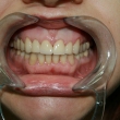 Протезирование зубов, виниры (Ксения, 40 лет)