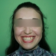 Исправление прикуса в Ростове (Лилиана, 24 года)-Стоматология «ВИД»