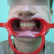 Протезирование зубов, виниры (Дмитрий, 26 лет)