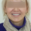 Исправление прикуса, имплантация, виниры (Ирина, 50 лет)