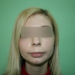Исправление прикуса в Ростове ( Анна, 25 лет)-Стоматология «ВИД»