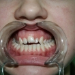 Имплантация и протезирование зубов (Евгения, 18 лет)