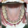 Исправление прикуса, реставрация зубов (Елена, 34 года)