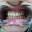 Исправление прикуса, имплантация зубов (Елена, 19 лет)