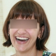 Исправление прикуса (Анжела, 35 лет)-Стоматология «ВИД»