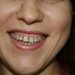 Протезирование зубов, виниры (Ксения, 40 лет)