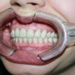 Протезирование зубов, виниры (Алена, 30 лет) -Стоматология «ВИД»
