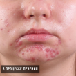 Лечение акне на лице (София, 18 лет)-Косметология ВИД