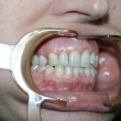 Эстетическая реставрация зубов (Лариса, 48 лет)
