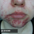 Лечение акне на лице (София, 18 лет)-Косметология ВИД