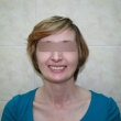 Протезирование зубов, бюгельный протез (Галина, 50 лет)