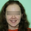 Исправление прикуса (Наталья, 22 года)-Стоматология «ВИД»