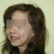 Исправление прикуса (Юлия, 12 лет)-Стоматология «ВИД»