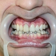 Комплексное стоматологическое лечение (Александр, 38 лет)
