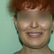 Эстетическая реставрация зубов (Лариса, 48 лет)