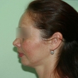 Исправление прикуса (Евгения, 38 лет) -Стоматология «ВИД»