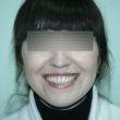 Исправление прикуса в Ростове (Лилиана, 24 года)-Стоматология «ВИД»