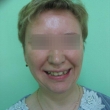 Исправление прикуса (Светлана, 38 лет) -Стоматология «ВИД»