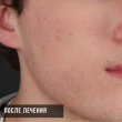 Лечение акне на лице (Игорь, 18 лет)-Косметология ВИД