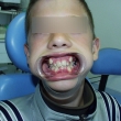 Исправление прикуса (Андрей, 13 лет) -Стоматология «ВИД»