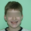 Исправление прикуса (Алексей, 12 лет)- Стоматология «ВИД»