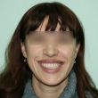 Исправление прикуса, реставрация зубов (Елена, 34 года)