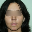 Исправление прикуса в Ростове (Оксана, 34 года)-Стоматология «ВИД»