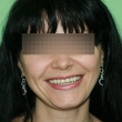 Протезирование зубов, виниры (Алена, 30 лет) -Стоматология «ВИД»