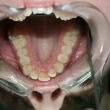 Имплантация и протезирование зубов (Евгения, 18 лет)