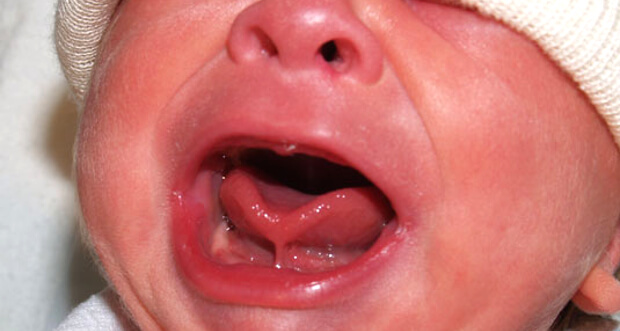 Подрезать уздечку под языком у ребенка